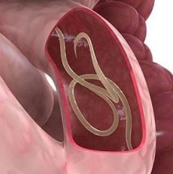 Signos de gusanos nunha persoa no estómago -intestino tracto